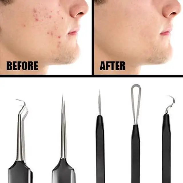 Alt view image 4 of 7 - Acne & Blackhead Remover Skin Care Tool Set for Men & Women - 5 Piece Pimple Popper Kit + Mirror! | Removal of Whiteheads, Zits, Black Heads, Comedone Extractor | As Seen on Shark Tank