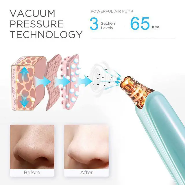 Alt view image 2 of 6 - Blackhead Remover Pore Vacuum Cleaner - Upgraded Facial Pore Cleaner - Electric USB Pore Vacuum with 5 Probes - Upgraded Blackhead Suction Tool - Blackhead Remover Kit