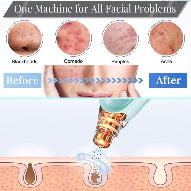 Alt view image 6 of 6 - Blackhead Remover Pore Vacuum Cleaner - Upgraded Facial Pore Cleaner - Electric USB Pore Vacuum with 5 Probes - Upgraded Blackhead Suction Tool - Blackhead Remover Kit