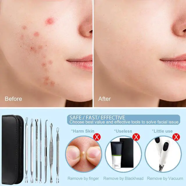 Alt view image 7 of 7 - 7 in 1 Pimple Popper Tool Kit - Blackhead Remover, Pimple Extractor, Comedone Extractor for Face