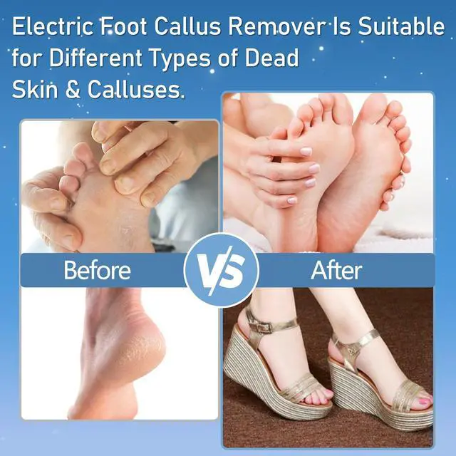 Alt view image 4 of 7 - Electric Foot Callus Remover Electric Callus Remover for Feet Waterproof with 3 Rollers 2 Speed Battery Display,17 in1 Rechargeable Foot File Pedicure Kits for Dead Hard Cracked Dry Skin