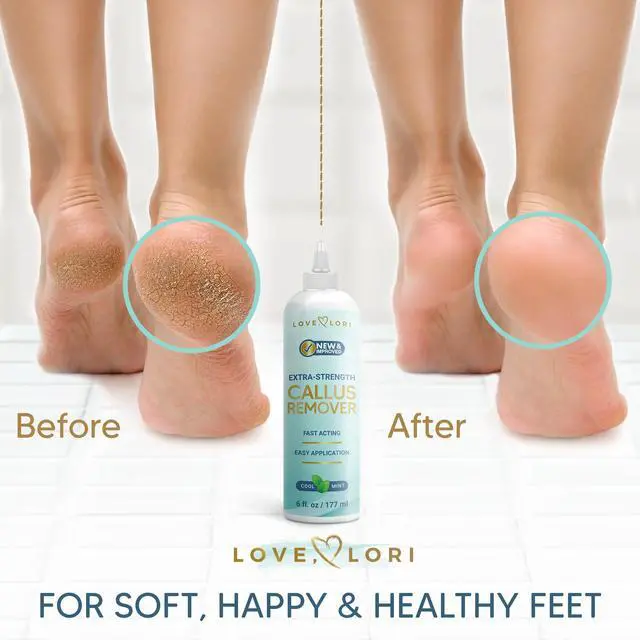 Alt view image 3 of 7 - Feet (Extra Strength) Foot Callus Remover Gel - Pedicure Tools for Feet Scrubber Foot Care Spa Essentials, 6oz