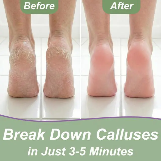 Alt view image 4 of 7 - Dr. Entre's Callus Remover Gel & Foot File: Extra Strength Callus Remover for Feet, Foot Callus Remover Care, Pedicure Tools Supplies, Spa Kit, Dead Skin Scrubber, 4 oz