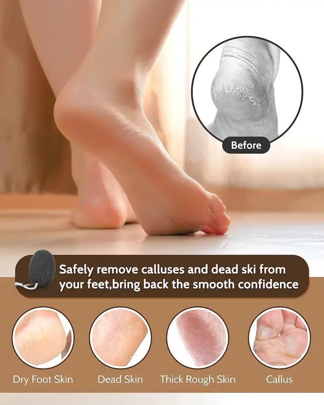 Alt view image 5 of 7 - Pumice Stone Foot File, 4pcs Set Callus Remover for Feet with Wooden Handle, Pedicure Foot Scrubber to Remove Dead Skin, Dry, Rough, Corns Skin Scraper
