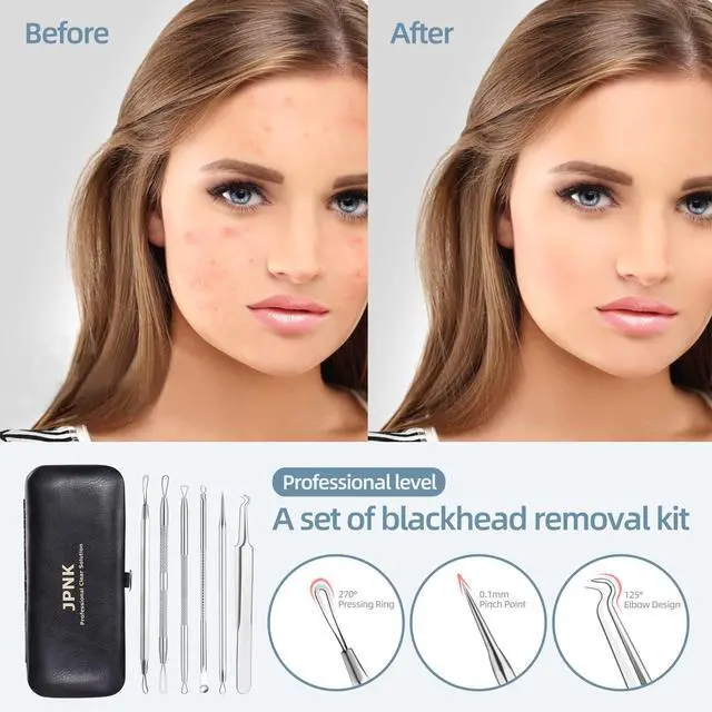 Alt view image 2 of 7 - Blackhead Remover Comedone Extractor Acne Removal Kit..
