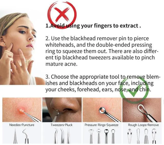 Alt view image 2 of 7 - Pimple Popper Tool, Blackhead Remover Acne and Zit Comedone Extractor Kit
