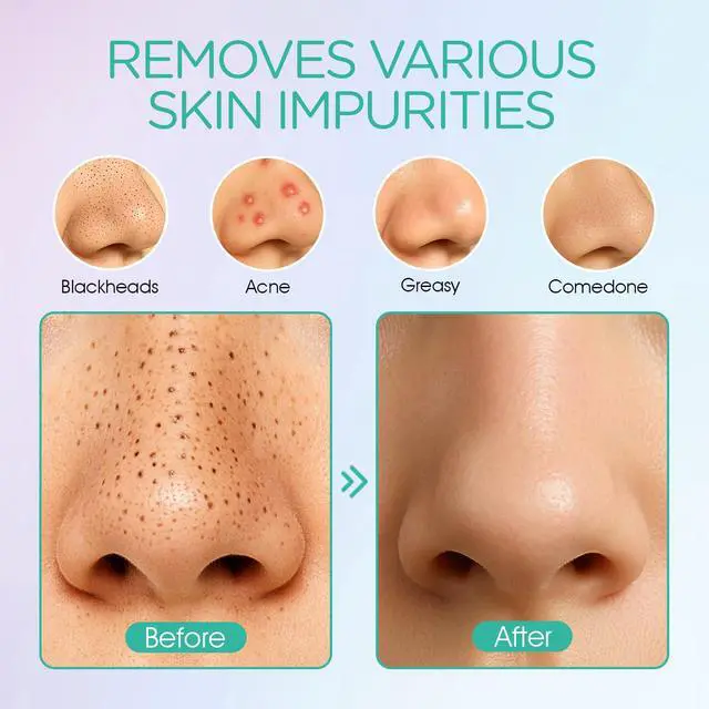 Alt view image 3 of 7 - Blackhead Remover Pore Vacuum - Electric Face Vacuum Pore Cleaner Acne White Heads Removal with 6 Suction Heads (BR410)