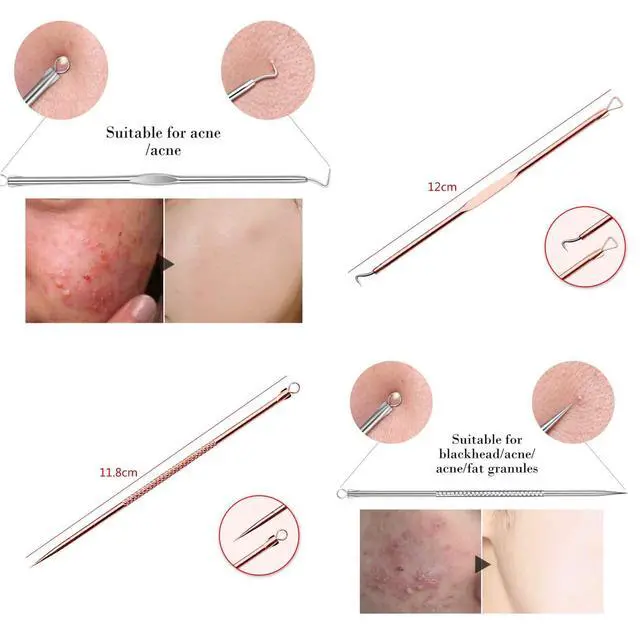 Alt view image 5 of 7 - Blackhead Remover Pimple Comedone Extractor Tool Best Acne Removal Kit - Treatment for Blemish, Whitehead Popping, Zit Removing for Risk Free Nose Face Skin with Case (Rose)