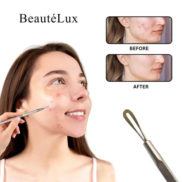 Alt view image 5 of 7 - 2-in-1 Blackhead Remover Tool, Stainless Steel Extractor