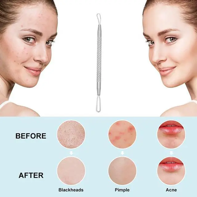 Alt view image 5 of 6 - Professional Blackhead and Blemish Remover -Pimple Comedone Removal 2-in-1 Extractor Tool
