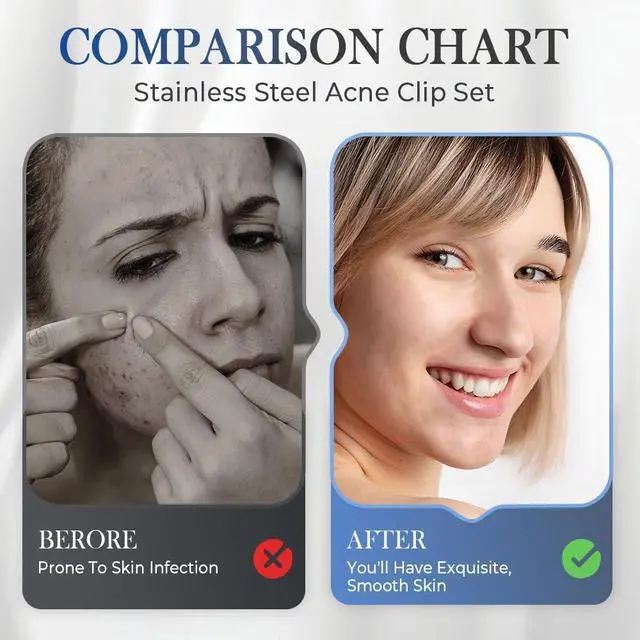 Alt view image 2 of 7 - 2026 Medical Grade Blackhead Extraction Tool Kit, Professional Facial Blackhead Remover Tweezers, Grade Extractor Tool for Removal Black Heads, Whiteheads, Pimples, Blemishes and Pimples