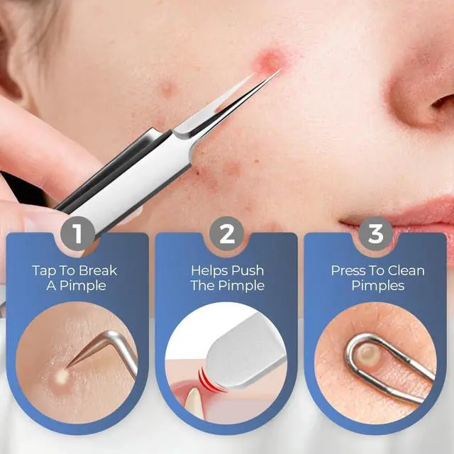 Alt view image 5 of 7 - 2026 Medical Grade Blackhead Extraction Tool Kit, Professional Facial Blackhead Remover Tweezers, Grade Extractor Tool for Removal Black Heads, Whiteheads, Pimples, Blemishes and Pimples