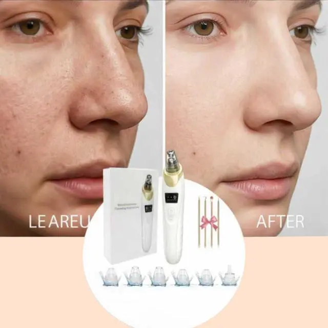 Alt view image 6 of 7 - 2026 Blackhead Remover with 5 Suction Heads & 4 Gold Extraction Tools, Electric Blackhead Vacuum Pore Vacuum for Deep Facial Cleaning, USB Rechargeable for Women & Men