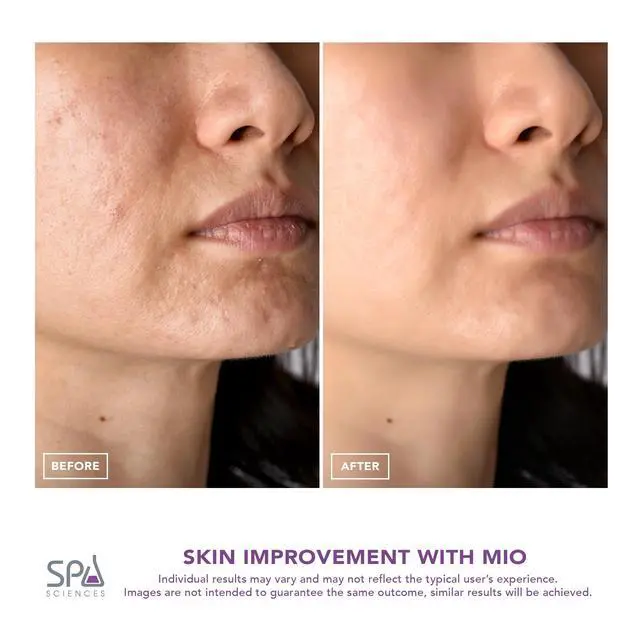 Alt view image 7 of 7 - Diamond Tip Microdermabrasion Blackhead Remover, Pore Cleansing, & Resurfacing System - Reduces Acne Scars, Wrinkles, and Exfoliates for Clearer Skin
