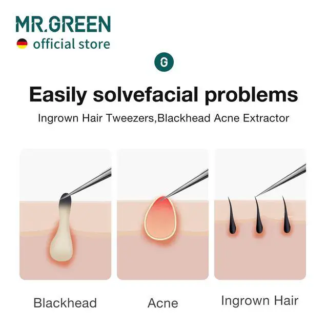Alt view image 3 of 7 - Ingrown Hair Tweezers Needle Nose Pointed Tips Tweezers For Eyebrows Splinters Blackhead Removal Acne Clip Extractor (Long)