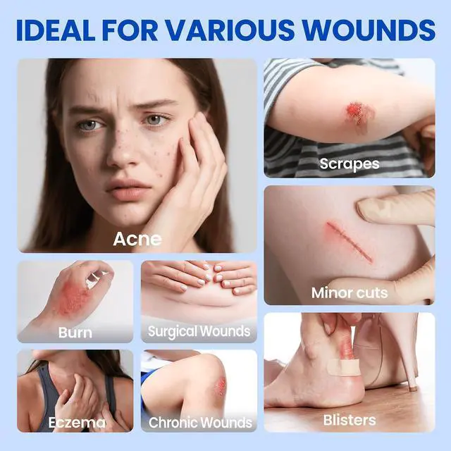 Alt view image 3 of 6 - Hydrocolloid Roll Large Adhesive Bandages Medical Grade Tape Wound Care Dressing, Acne Care, Bed Sore,Burn, Blister, Highly Absorbent for Sterile and Waterproof (2in x 5ft)