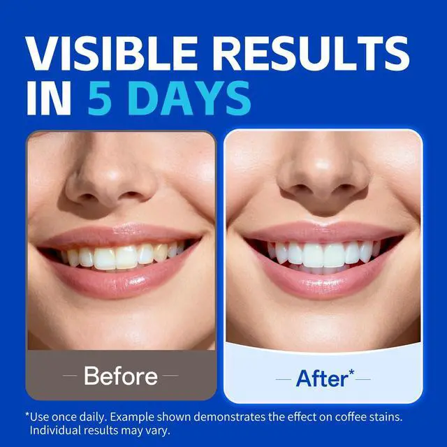 Alt view image 2 of 7 - PERSMAX Teeth Whitening Strips 14 Treatment, 28 Non-Slip Strips