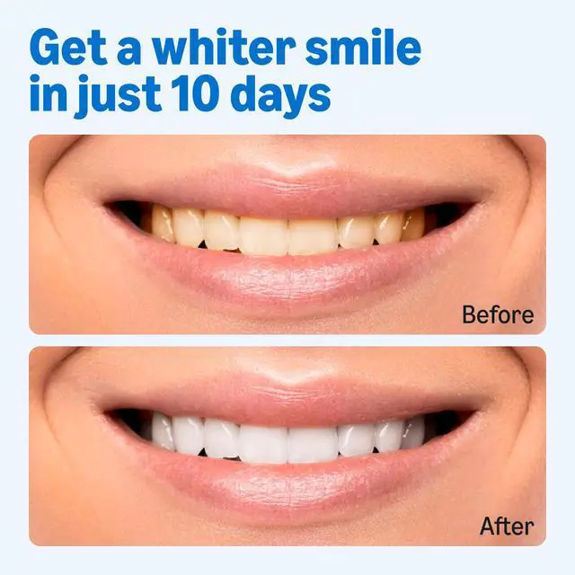 Alt view image 4 of 7 - 10 Day Teeth Whitening Strips Kit, 10 Treatments, 1-Pack, Packaging May Vary