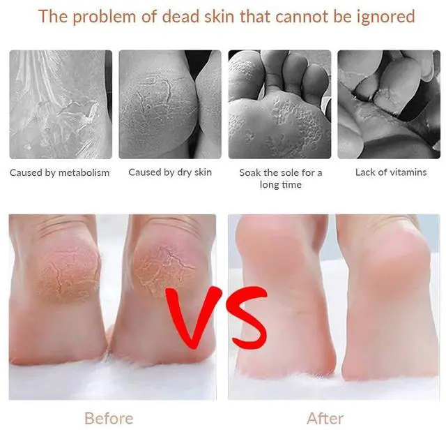Alt view image 6 of 7 - Pedicure Callus Shaver Foot File Care Hard Skin Remover Sets with Case