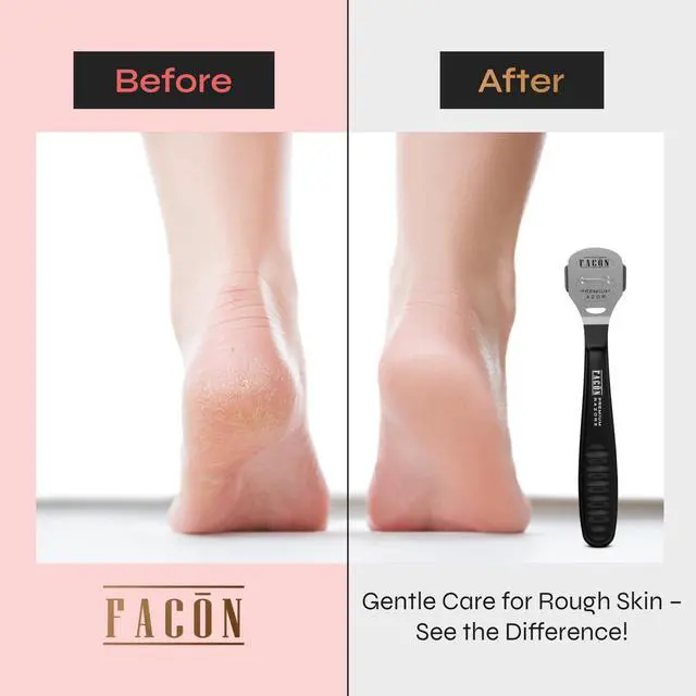Alt view image 3 of 7 - Facón Professional Callus Shaver Remover with 50 Blades, Pedicure Razor for Feet & Hands, Foot Razor for Callus Removal, Callus Blade Remover, Corn Shaver, Surgical Grade Premium Stainless Steel Tool