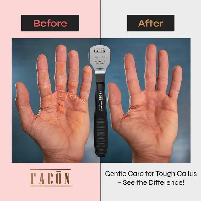 Alt view image 4 of 7 - Facón Professional Callus Shaver Remover with 50 Blades, Pedicure Razor for Feet & Hands, Foot Razor for Callus Removal, Callus Blade Remover, Corn Shaver, Surgical Grade Premium Stainless Steel Tool