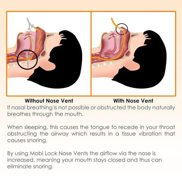Alt view image 7 of 7 - Vent Sinus Relief Dilator (Pack of 8 Various Sizes) - A Simple Solution for Nasal Snorers - Reusable Snoring Device to Enjoy a Peaceful Night's Sleep