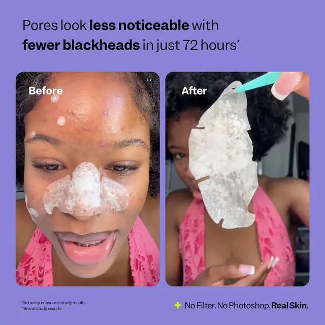 Alt view image 6 of 7 - Peach Slices - Nose Pore Patches (7 ct) - Overnight Blackhead Remover - Pore Strips - Absorbs Gunk - Thin, Flexible & Painless - Hydrocolloid Patches - Vegan & Cruelty Free - Korean Skin Care & Beauty