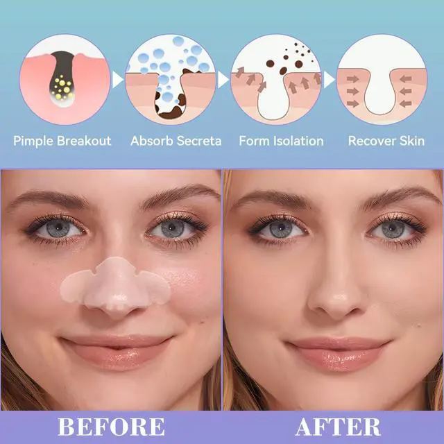 Alt view image 2 of 6 - Vigorder Nose Pore Patches, Hydrocolloid Nose Patches, Targets Pimple, Pores & Oil, Acne Strips to Absorb Acne Gunk Overnight (10 Pack)