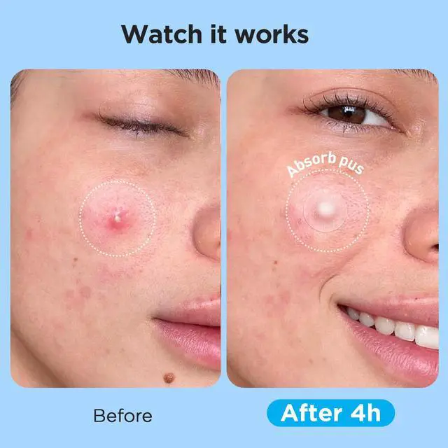 Alt view image 4 of 7 - Glowpatch Pimple Patches for Face (504 Count), FSA Eligible Acne Patch Bulk, Zit Stickers 4 Sizes, Hydrocolloid Spot Stickers, Clear Acne Dots for Covering Zits, Blemishes and Breakouts