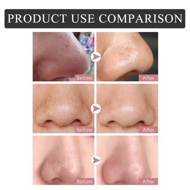 Alt view image 4 of 7 - Caunmy Blackhead Remover Nose Pore Strips - Deep Cleansing and Moisture Clear-Up Strips for Blackheads, for Women & Men (20 PCS)
