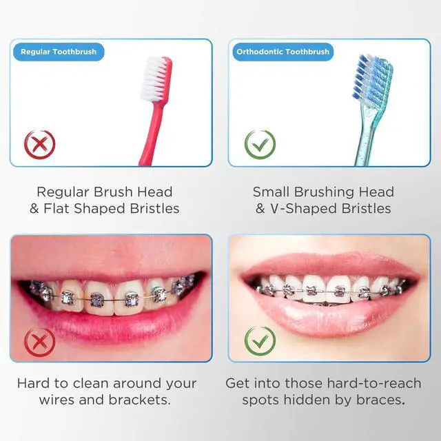 Alt view image 7 of 7 - V-Shaped Orthodontic Toothbrush for Braces, with 6 Interdental Brushes, Soft Bristles, 6 Count