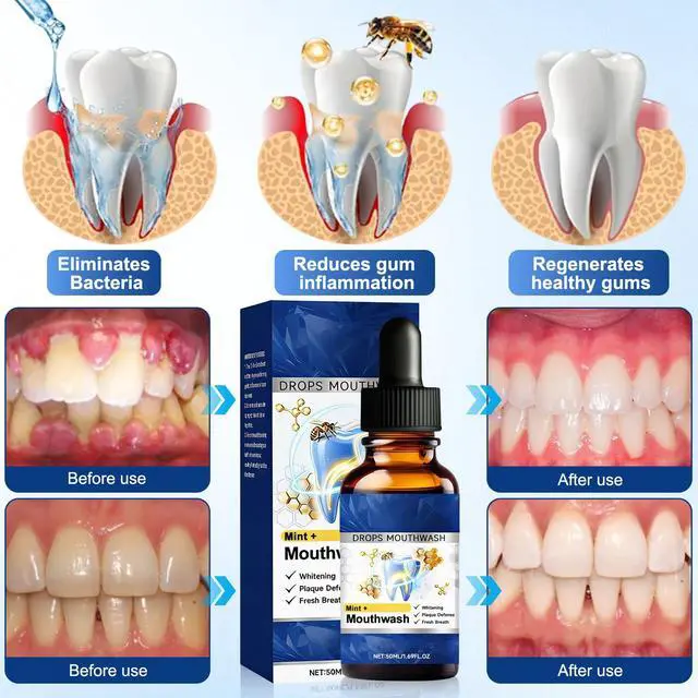 Alt view image 2 of 7 - 2PCS Beetakt Oral Repair Solution, Mint Flavored Oral Mouthwash, Professional Gum Restore Drops, Teeth Restoration, Effectively Improves Oral Hygiene and Freshens Breath