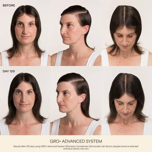 Alt view image 2 of 7 - Scalp Dermaroller - MD-Developed, 1,200 Medical-Grade Needles, Enhances Serum Absorption, Twist-On Replaceable Head, Protective Case Included