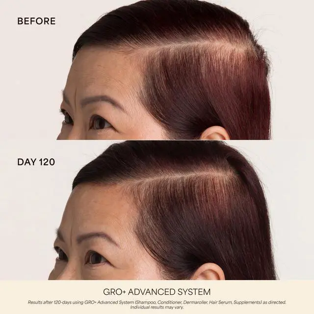 Alt view image 3 of 7 - Scalp Dermaroller - MD-Developed, 1,200 Medical-Grade Needles, Enhances Serum Absorption, Twist-On Replaceable Head, Protective Case Included