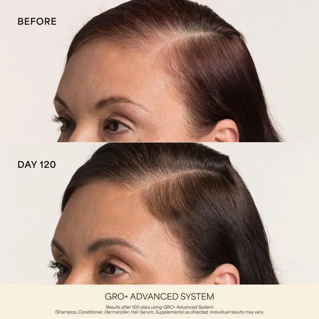 Alt view image 4 of 7 - Scalp Dermaroller - MD-Developed, 1,200 Medical-Grade Needles, Enhances Serum Absorption, Twist-On Replaceable Head, Protective Case Included