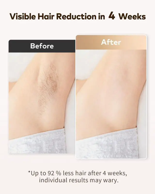 Alt view image 2 of 7 - Hair Removal for Women and Men, Safe at-Home Hair Removal Device, Hair Laser Removal with Long-Lasting in Hair Reduction for Armpits Back Legs Arms Face Bikini Line