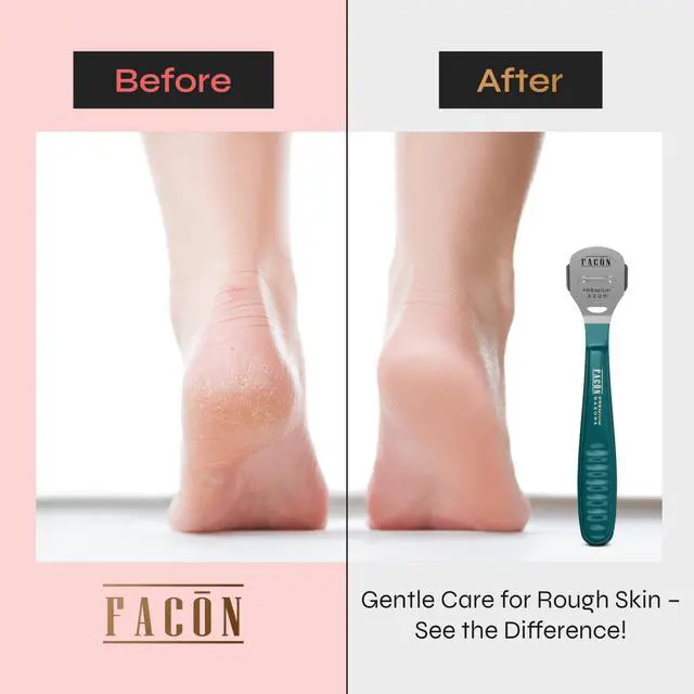 Main image of Professional Callus Shaver Remover with 50 Blades, Pedicure Razor for Feet & Hands, Foot Razor for Callus Removal, Callus Blade Remover, Corn Shaver, Surgical Grade Premium Stainless Steel Tool