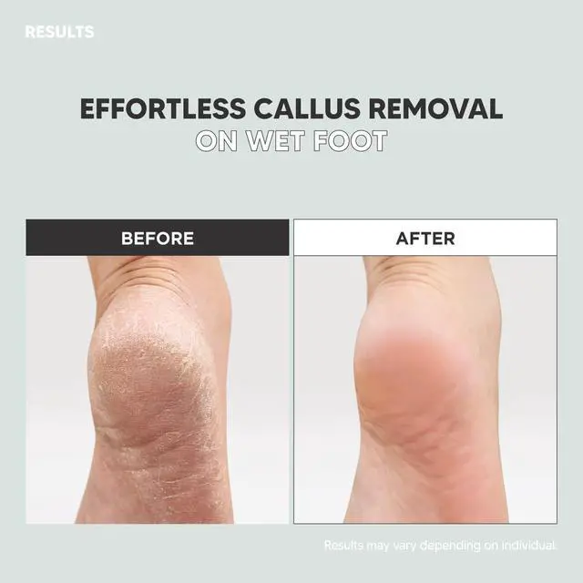 Alt view image 5 of 6 - Stainless Steel Callus Remover(Sky Blue), Effective for Thick Callus and Cracked Feet Pedicure Rasp, Remove Hard Skin, Grater Foot File, Foot Scrubber, Professional Foot Care