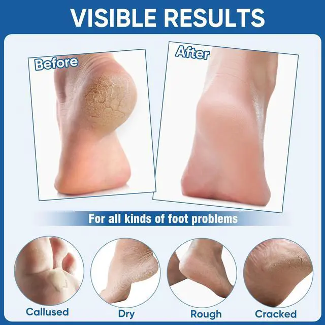 Alt view image 7 of 7 - Nano Glass Foot File, Foot Callus Remover & Scrubber for Smooth Feet, Professional Pedicure Tool (Heel Socks & Cracked Heel Stick Included)