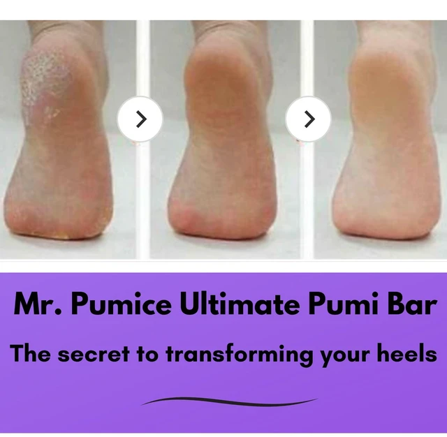 Alt view image 3 of 7 - Ultimate PUMI Bar 2-in-1 Dual Grit (Medium + Coarse) Callus Remover, Pedicure Stone & Ped File Scrubber for Smooth Feet and Heels (4 Pack)