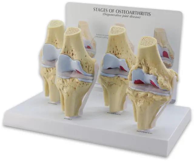 Main image of Knee Set 3/4 size Osteoarthritis Set of 4 Anatomical Model w Educational Key Card | Human Body and Anatomy Replica for Physiology Education, Anatomical Model for Doctor's Office, Medical Learning Reso