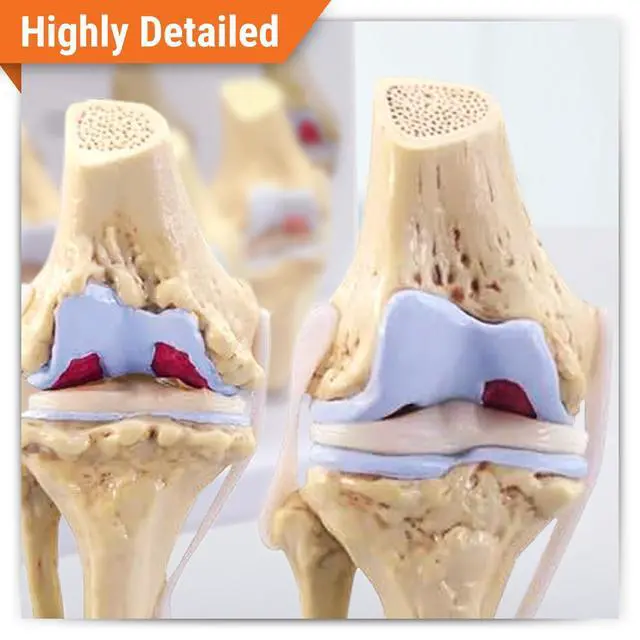 Alt view image 2 of 6 - Knee Set 3/4 size Osteoarthritis Set of 4 Anatomical Model w Educational Key Card | Human Body and Anatomy Replica for Physiology Education, Anatomical Model for Doctor's Office, Medical Learning Reso