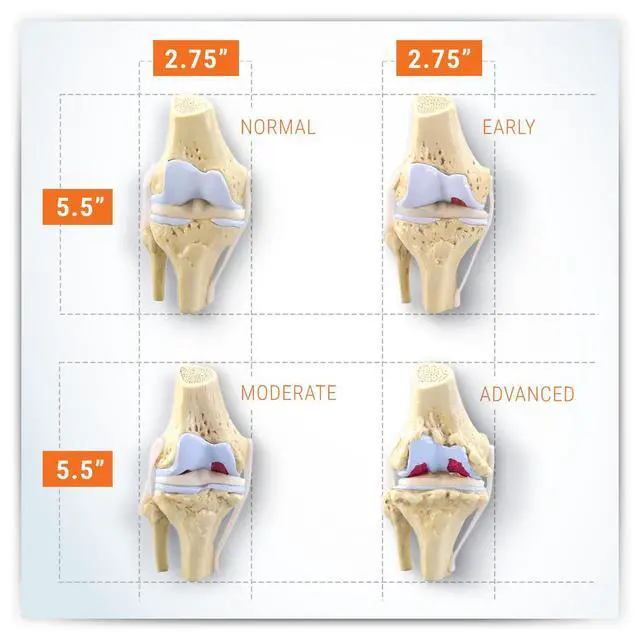Alt view image 5 of 6 - Knee Set 3/4 size Osteoarthritis Set of 4 Anatomical Model w Educational Key Card | Human Body and Anatomy Replica for Physiology Education, Anatomical Model for Doctor's Office, Medical Learning Reso