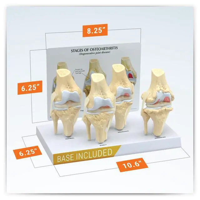Alt view image 6 of 6 - Knee Set 3/4 size Osteoarthritis Set of 4 Anatomical Model w Educational Key Card | Human Body and Anatomy Replica for Physiology Education, Anatomical Model for Doctor's Office, Medical Learning Reso
