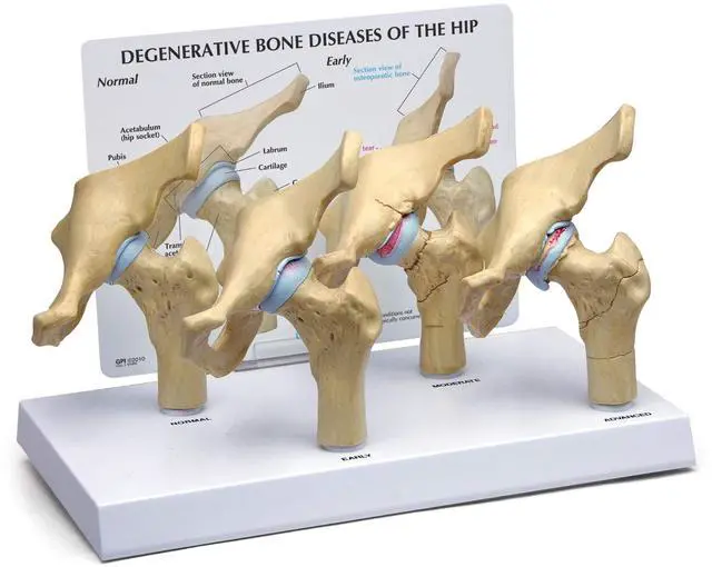 Main image of 4-Stage Diseased Hip Joint Model Set | Human Body and Anatomy Replica for Physiology Education, Anatomical Model for Doctor's Office, Medical Learning Resources