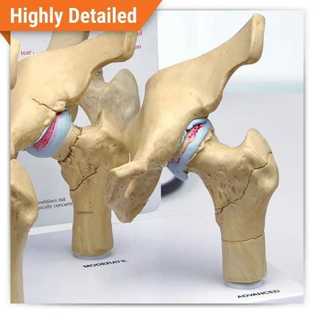 Alt view image 2 of 6 - 4-Stage Diseased Hip Joint Model Set | Human Body and Anatomy Replica for Physiology Education, Anatomical Model for Doctor's Office, Medical Learning Resources