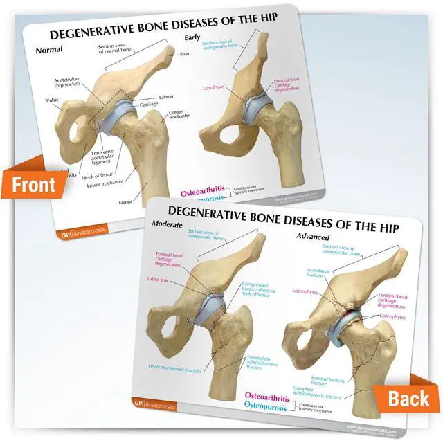 Alt view image 5 of 6 - 4-Stage Diseased Hip Joint Model Set | Human Body and Anatomy Replica for Physiology Education, Anatomical Model for Doctor's Office, Medical Learning Resources