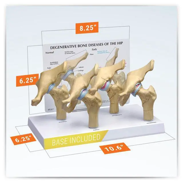 Alt view image 6 of 6 - 4-Stage Diseased Hip Joint Model Set | Human Body and Anatomy Replica for Physiology Education, Anatomical Model for Doctor's Office, Medical Learning Resources