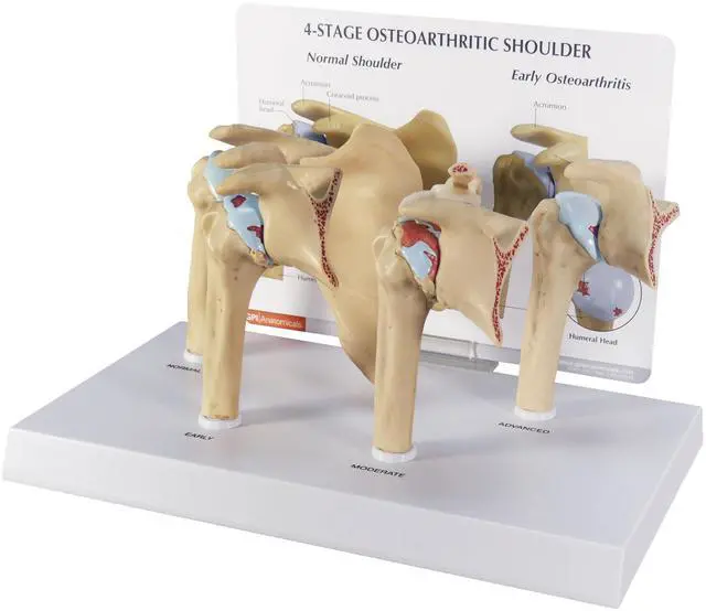 Main image of Shoulder Osteoarthritic (OA) 4-Stage Anatomical Model | Human Body and Anatomy Replica for Physiology Education, Anatomical Model for Doctor's Office, Medical Learning Resources