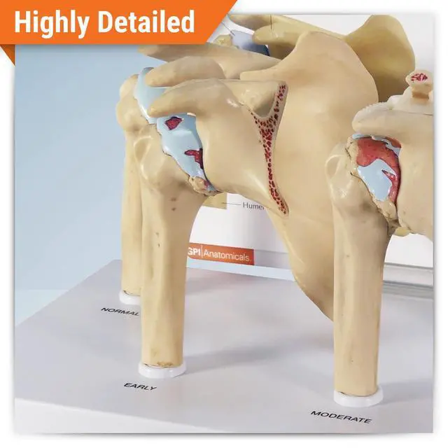 Alt view image 2 of 6 - Shoulder Osteoarthritic (OA) 4-Stage Anatomical Model | Human Body and Anatomy Replica for Physiology Education, Anatomical Model for Doctor's Office, Medical Learning Resources